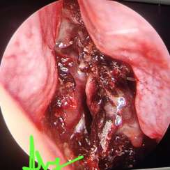 MUCORMYCOSIS: A POST COVID SEQUELAE